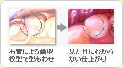 (草加市 歯科)セラミックインレー