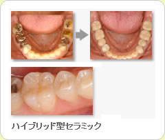 (草加市 歯科)セラミッククラウン