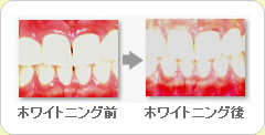 (草加市 歯科)ホワイトニング