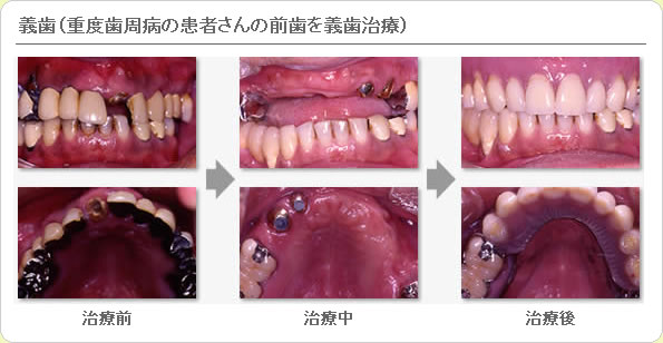 (草加市 歯科)義歯（重度歯周病の患者さんの前歯を義歯治療）