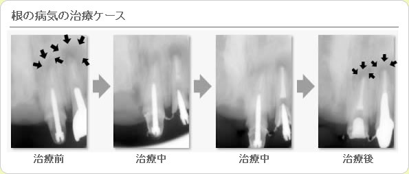 (草加市 歯科)根の病気の治療ケース