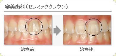 (草加市 歯科)審美歯科（セラミッククラウン）