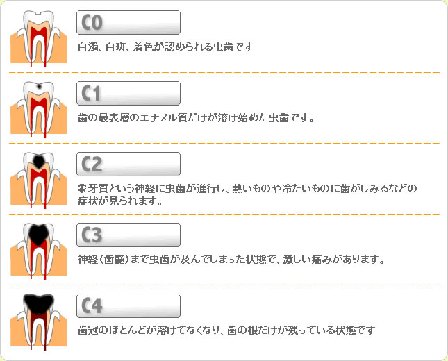 (草加市 歯科)虫歯の種類