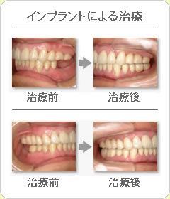 (草加市 歯科)インプラントによる治療