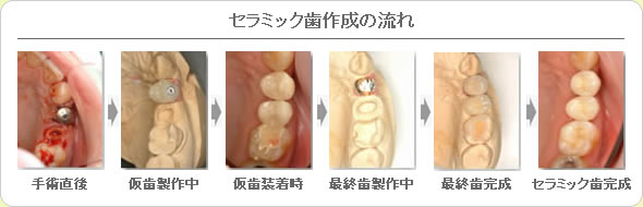 (草加市 歯科)セラミック歯作成