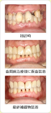 (草加市 歯科)歯周病治療