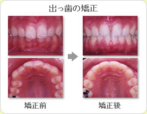(草加市 歯科)出っ歯の矯正