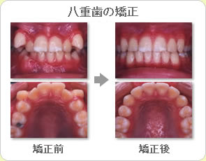 (草加市 歯科)八重歯の矯正
