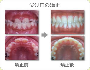 (草加市 歯科)受け口の矯正